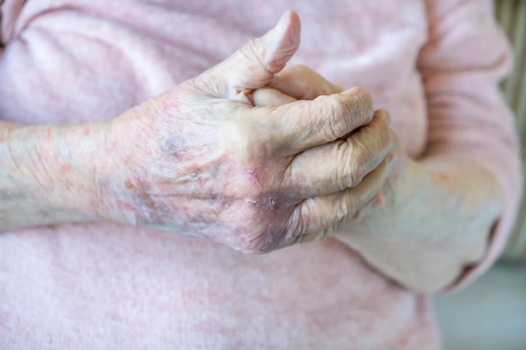 Ältere Damenhände mit Neurodermitis