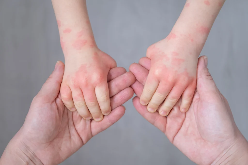 Kinderhände mit Neurodermitis halten Hände von Erwachsenen fest
